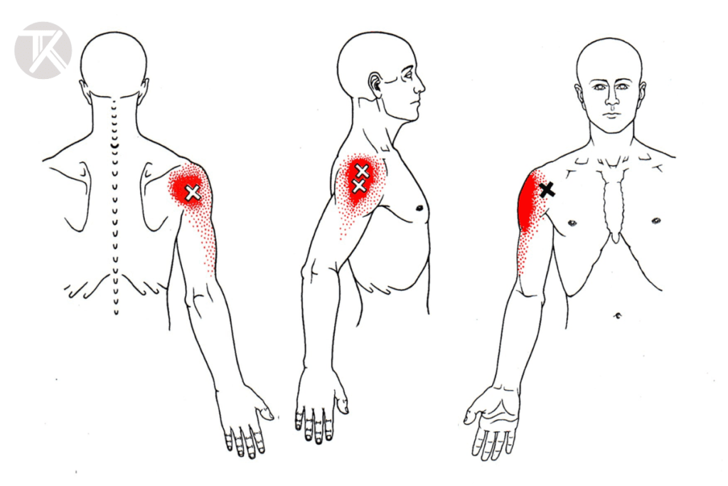 Myofascial pain deltoid